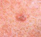 Basal skin cancer photo