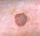 Squamous skin cancer photo